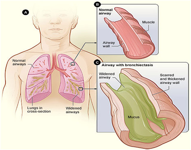 Bronchiectasis1